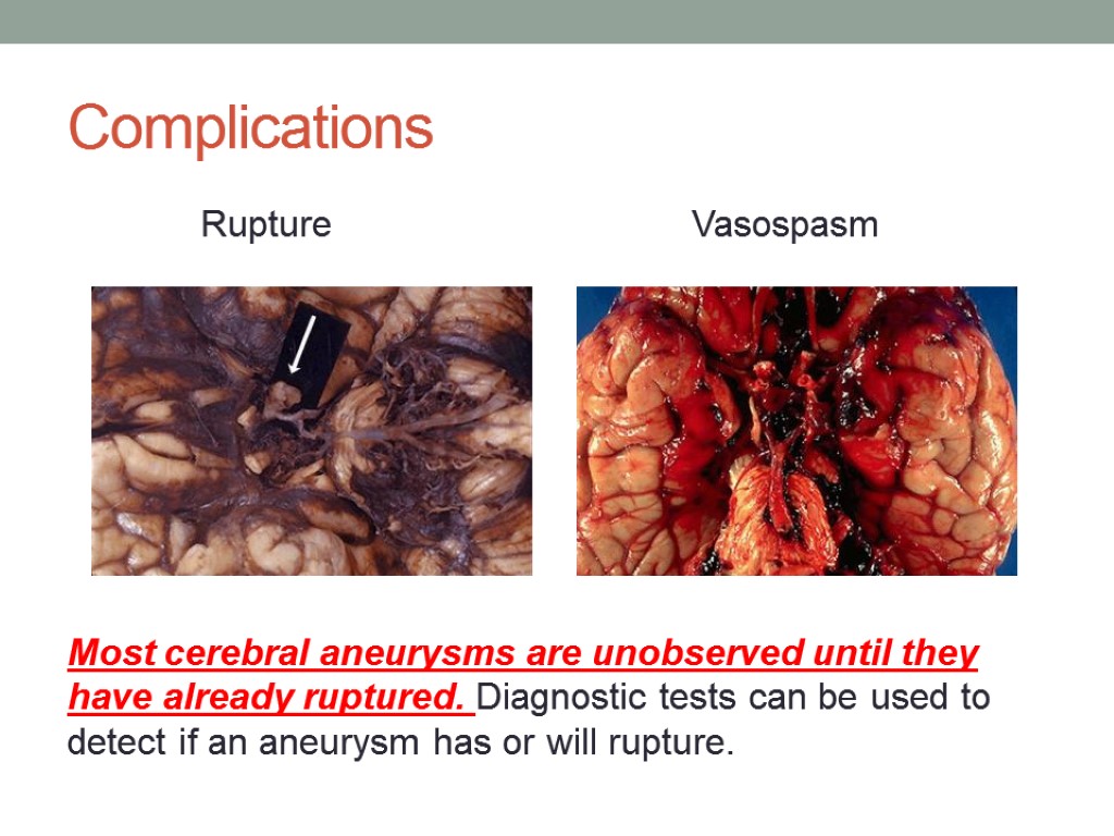 Complications Rupture Vasospasm Most cerebral aneurysms are unobserved until they have already ruptured. Diagnostic